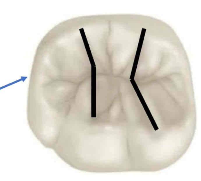 <p>how many transverse ridges does mandibular molars have?</p>