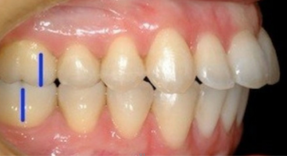 <p>Proinclined upper central incisors </p><p>increase in overjet</p>