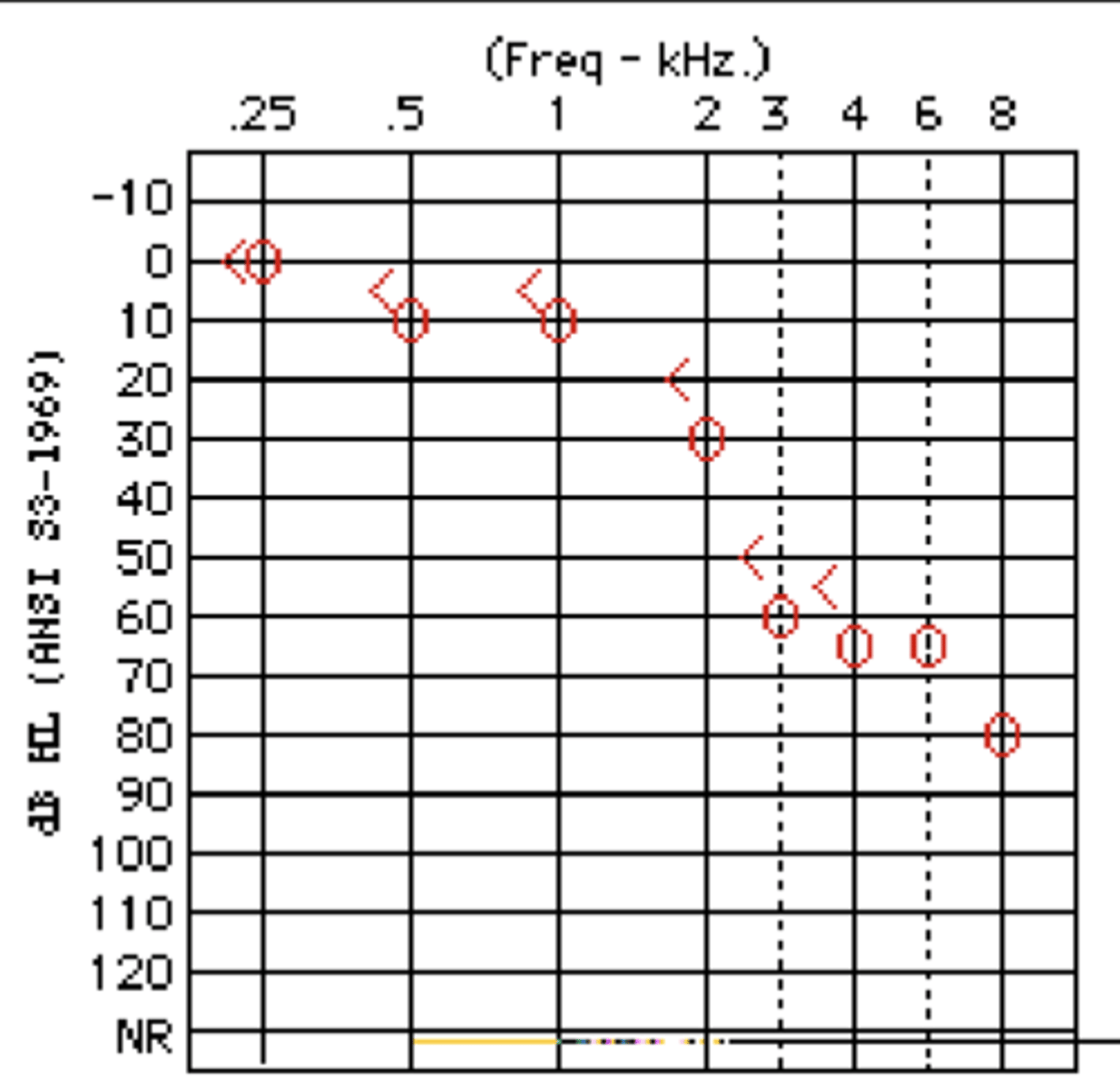 <p>- if both air conduction and bone conduction thresholds show hearing loss and the ABG &lt;10 dB (less than or equal to), there is a sensorineural loss.</p>