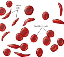 <p>Sickle Cell Anemia</p><ul><li><p>single substitution: T replaced w/ A</p></li><li><p>results in Valine protein = sickle cell hemoglobin (should be<strong> Glutamic acid)</strong></p><ul><li><p>non conservative missense mutation</p></li></ul></li></ul><p></p>