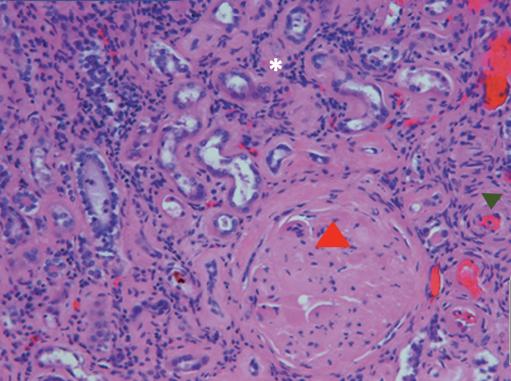 <p>What is the diagnosis?</p><p>What is shown at the green triangle?</p><p>What is shown at the red triangle?</p><p>What is shown at the white asterisk?</p>