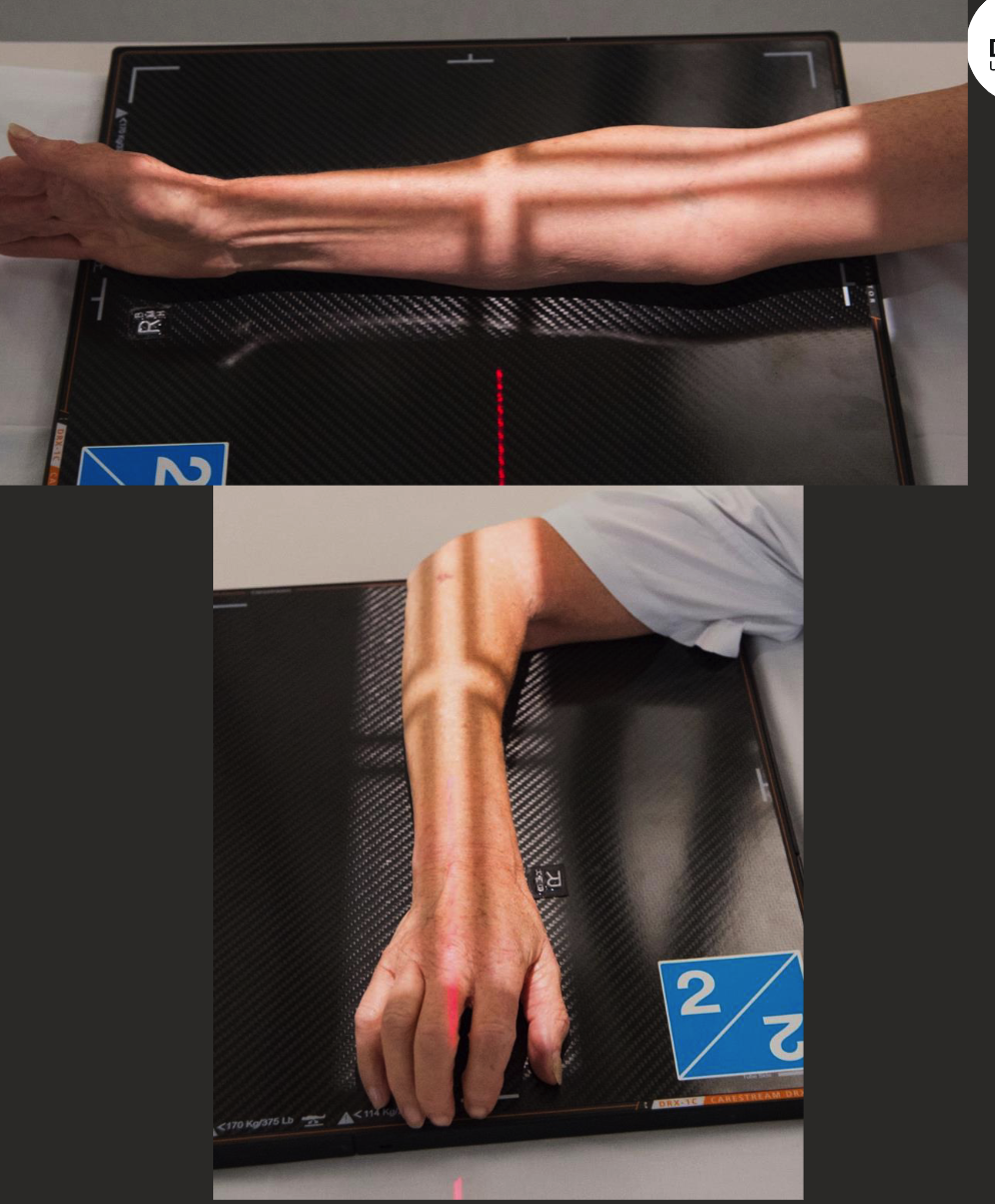 <ul><li><p>For when patient has limited ROM</p></li><li><p>AP elbow + lateral wrist (top).</p></li><li><p>Lateral elbow with PA wrist (bottom).</p></li></ul><p></p>