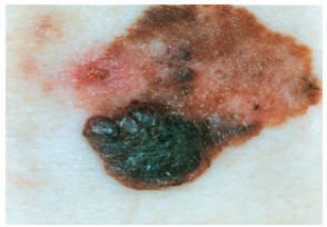 <p>melanoma</p>