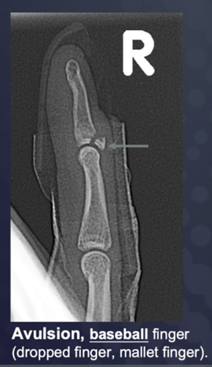 <p>Avulsion (occurs at the site of musculotendinous and ligamentous attachments)</p>