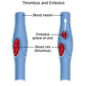 <p>Embolus</p>