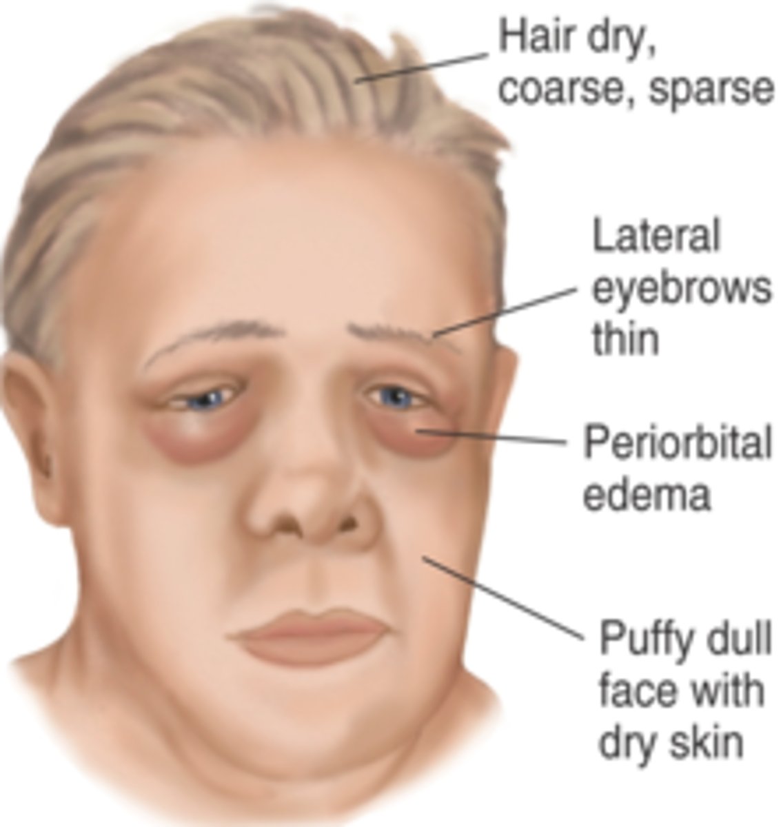 <p>hair dry, sparse</p><p>lateral eyebrows thin</p><p>periorbital edema</p><p>puffy dull face</p>