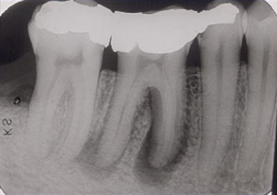 <p>What does the internal structure of a periapical inflammatory lesion look like?</p>