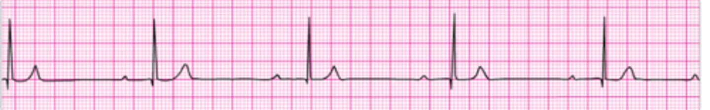 <p>You arrive on the scene to find CPR in progress. Nursing staff report that the patient was recovering from a pulmonary embolism and suddenly collapsed. There is no pulse or spontaneous respirations. High-quality CPR and effective bag-mask ventilation are being provided. An IV has been initiated. What would</p><p>you do now?</p><p>1. Give atropine 1 mg IV.</p><p>2. Give atropine 0.5 mg IV</p><p>3. Order immediate endotracheal intubation.</p><p>4. Give epinephrine 1 mg IV .</p><p>5. Initiate transcutaneous pacing.</p>