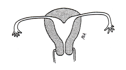 <p>What class mullerian defect?</p><ul><li><p><strong>arcuate uterus</strong> → variant of normal, no adverse impact on fertility and pregnancy outcomes</p></li><li><p>has slight midline septum w/ minimal and often broad fundal cavity indentation</p></li><li><p>variously classified as septate, bicornuate, or normal variant</p></li></ul><p></p>