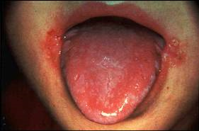 <p>A patient present to the office with sever cracks around his mouth and inflamed tongue. What is this, and what could have caused this? </p>