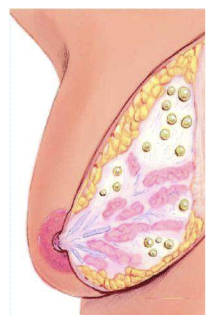 <ul><li><p>most common benign finding </p></li><li><p>thickening of generalized tissue with cyst formation (may be intermittent) </p></li><li><p>Age 30-50, regress after menopause except with estrogen therapy </p></li><li><p>Most common benign breast condition </p></li><li><p>Cysts are round, well delineated, soft to firm, and elastic feeling/bouncy </p></li><li><p>Cysts are mobile and often tender</p></li><li><p>On exam, overall nodular/dense feel </p></li><li><p>very painful before period </p></li></ul><p></p>