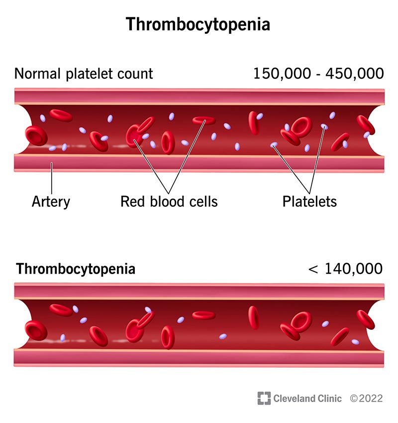 <p>a condition where the number of platelets in the blood is abnormally low</p>
