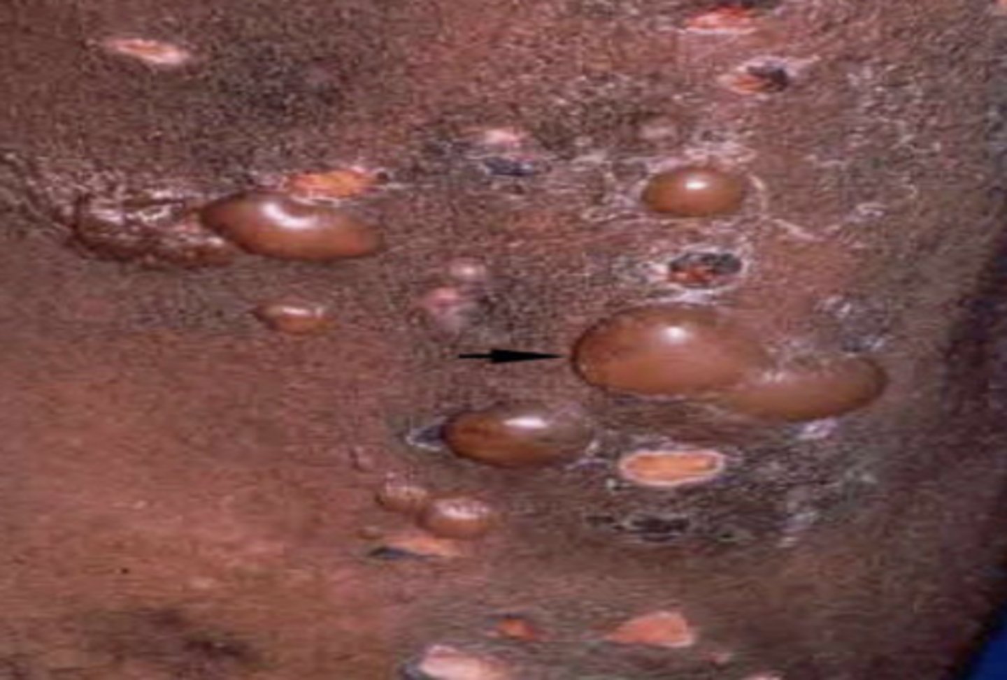 <p>A raised, fluid filled growth greater than 1.0 cm</p>