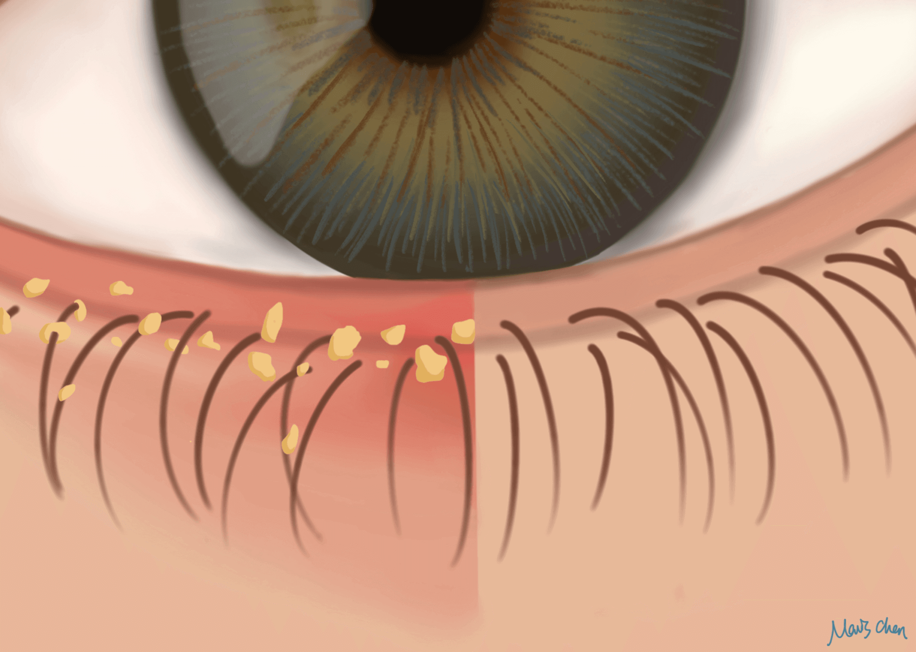 <p>Staphylococcal infection of the eyelid</p>