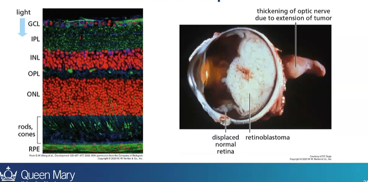 <p>retinoblastoma</p>