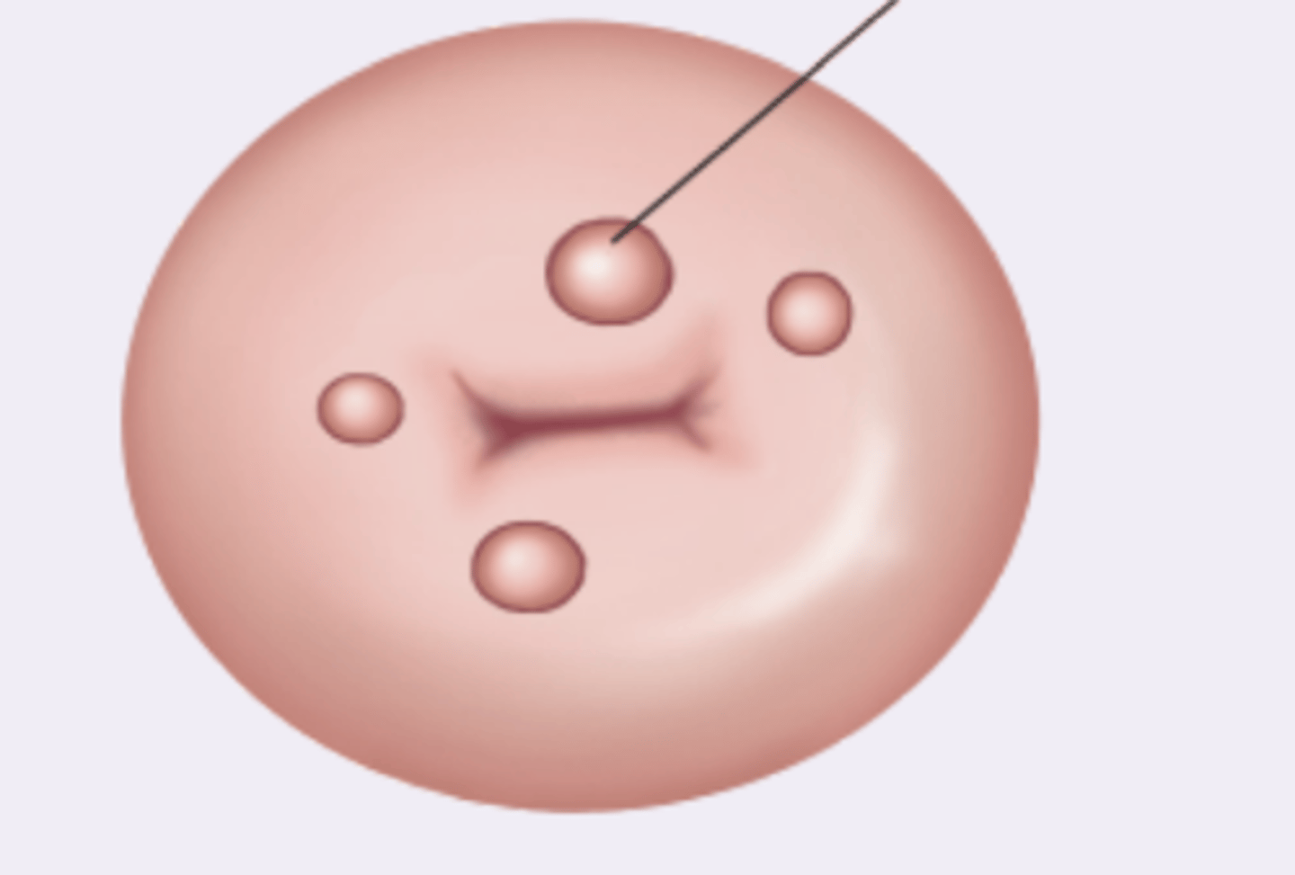 <p>translucent nodules on cervical surface, no pathologic significance, occur via metaplasia and blocking secretions of columnar epithelium</p>