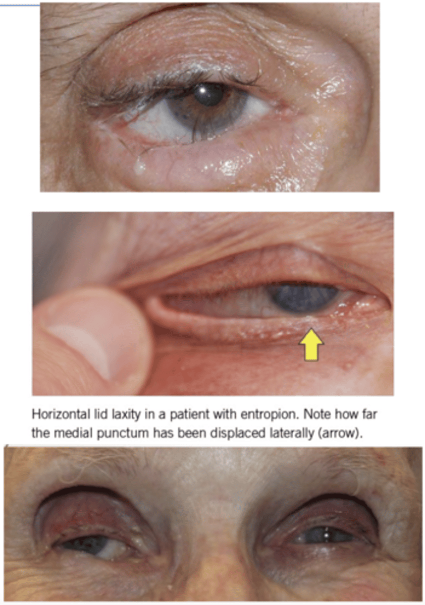 <p>What type of <strong>entropion</strong> happens due to "O'HARE"?</p><ul><li><p><strong><u>O</u></strong>veraction of palpebral part of orbicularis oculi</p><ul><li><p>Pulls inferior part of lower tarsal plate</p></li></ul></li><li><p><strong><u>H</u></strong>orizontal lid laxity caused by stretching of cantonal tendons</p></li><li><p><strong><u>A</u></strong>trophy of tarsal plate</p></li><li><p><strong><u>R</u></strong>etractor dehiscence of the lower eyelid retractors</p></li><li><p><strong><u>E</u></strong>nopthalmos of the globe</p></li></ul><p></p>