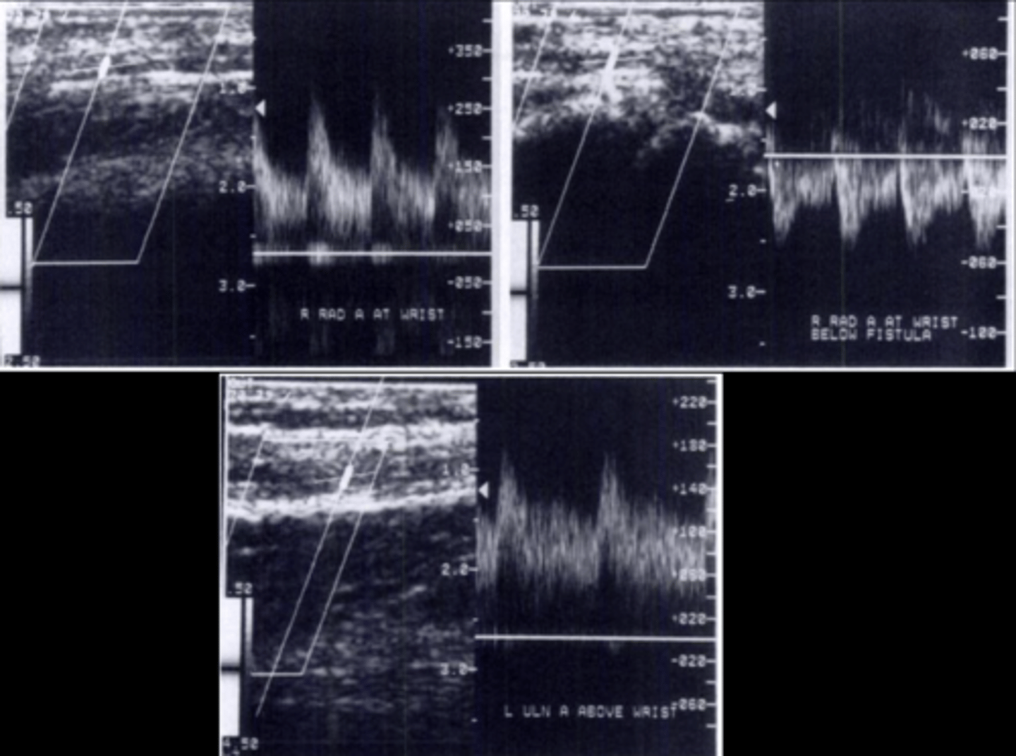 <p>Occurs in 75-90% of patients</p><p>Most patients are asymptomatic</p><p>Due to poor distal collateral circulation &amp; high flow through fistula</p><p>Low-resistant outflow vein draws antegrade flow from inflow artery &amp; steals retrograde flow from distal artery</p>