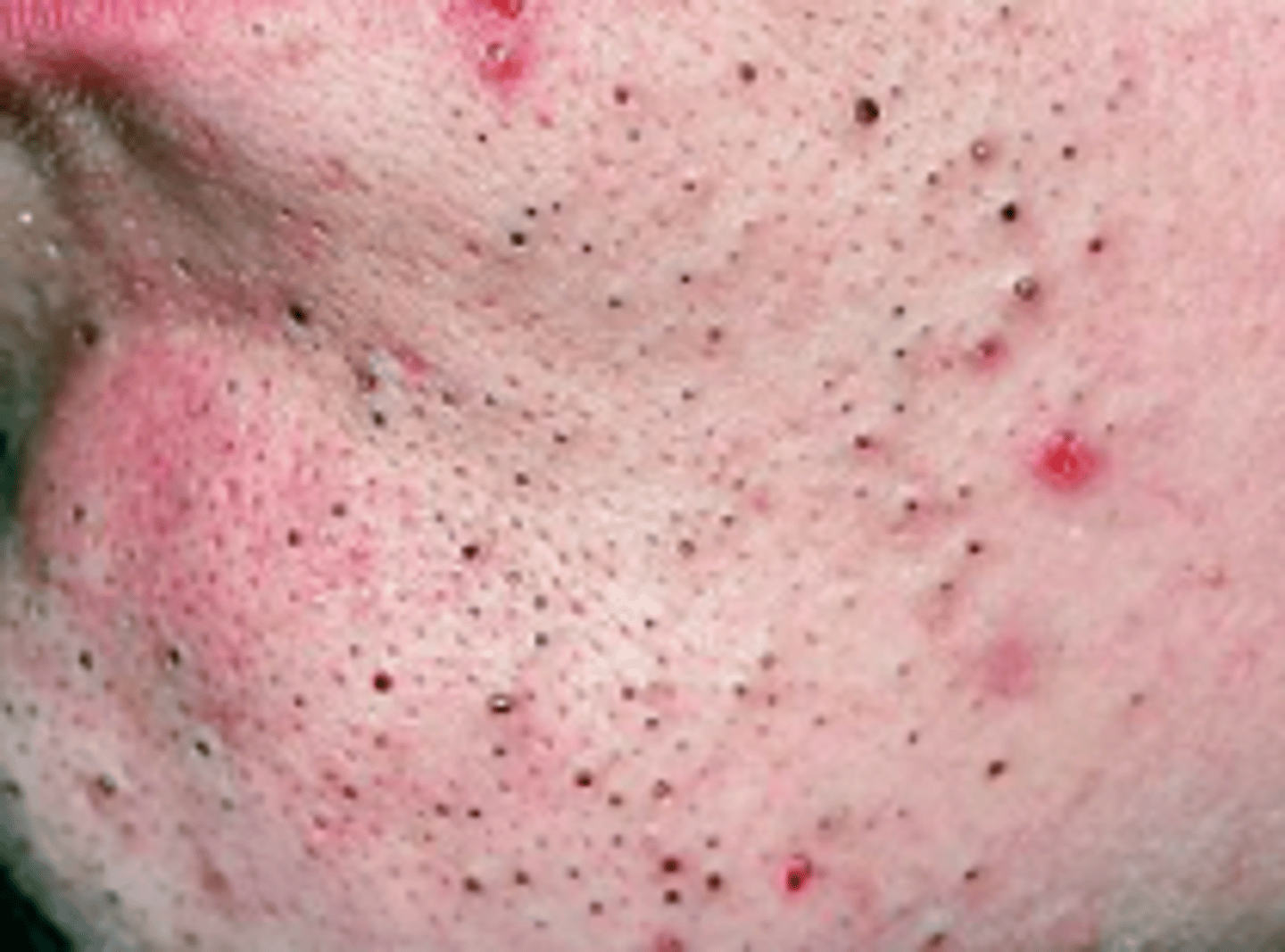 <p>Acneiform Disorders:</p><p>noninflammatory, &lt;5 mm papules with central, dilated, follicular orifice containing gray, brown, or black, keratotic material</p>