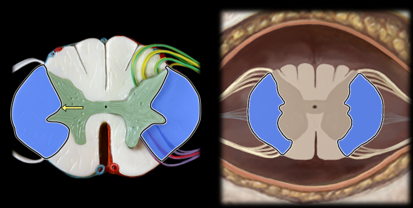 <p>Lateral funiculus</p>