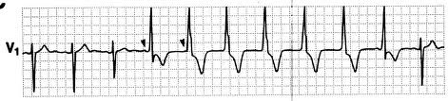 <p>40-120</p><p>- occur in short burst, usually following MI</p><p>- mostly asx with no progression to vtach / vfib</p>
