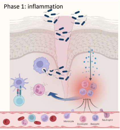 <p>Barrier breach sensed by PAMPS / DAMPS</p><ul><li><p><strong>Resident immune cells release a cascade of chemokines, histamine, and PGs</strong></p></li><li><p><span style="color: green;"><strong>This attracts circulating immune cells</strong></span>, <strong>causing vasodilation</strong></p></li><li><p><span style="color: green;"><strong>Induces selectins/adhesion molecules and integrins, </strong></span><strong>leading to infiltration of monocytes, granulocytes, and DCs.</strong></p></li></ul><p></p>