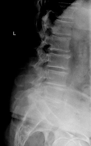 <ol><li><p>disc breakdown</p></li><li><p>vertebral end plates break down</p></li><li><p>disc can bulge into post. annulus and joint space narrow compressing nerves and causing stenosis </p></li></ol><p></p>