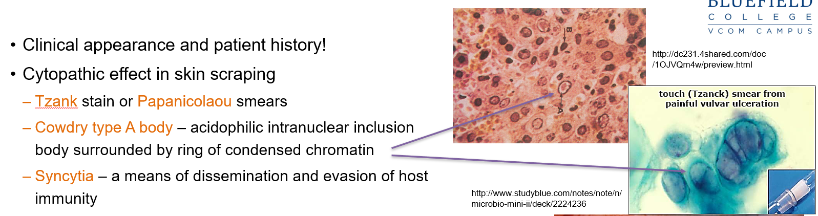 <p>An <strong>acidophilic intranuclear inclusion body</strong> surrounded by condensed chromatin, seen in HSV infections.</p>
