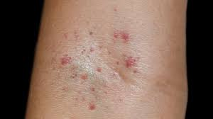 <p>What are minute, pinpoint, nonraised, perfectly round purplish-red spots caused by intradermal or submucous hemorrhage, which later turn blue or yellow?</p>