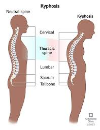 <p>what type of spinal curvature abnormality is this </p>