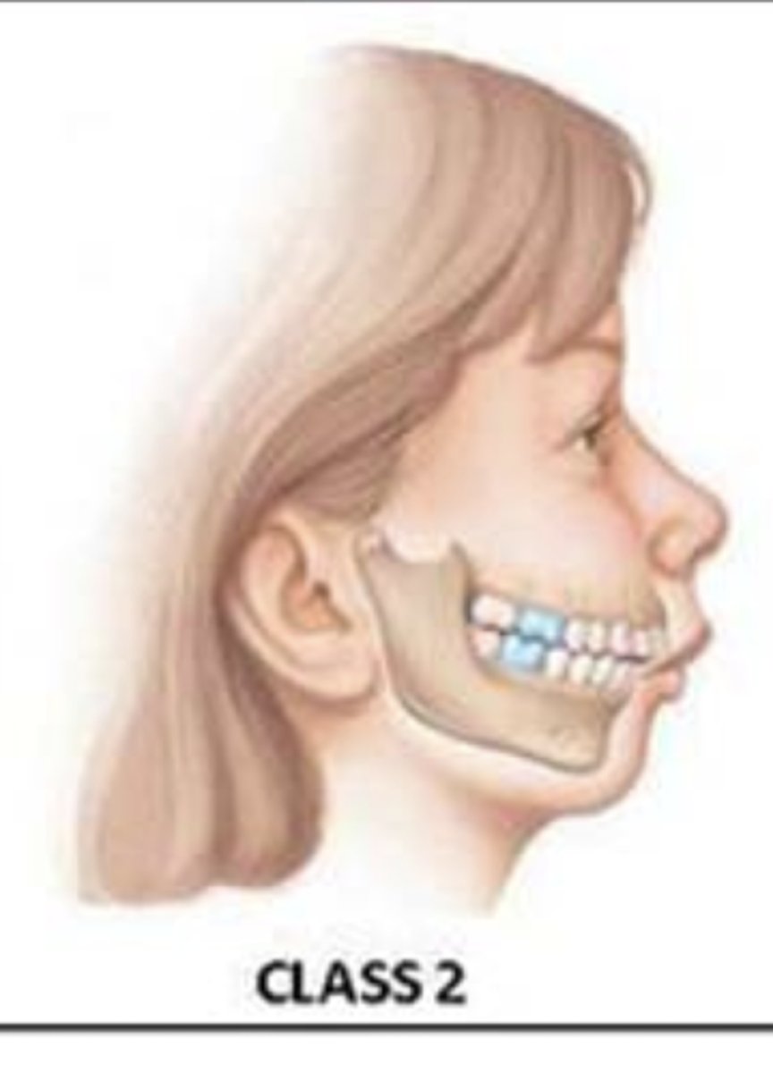 <p>The first molar of the lower jaw is posterior to the normal position</p>