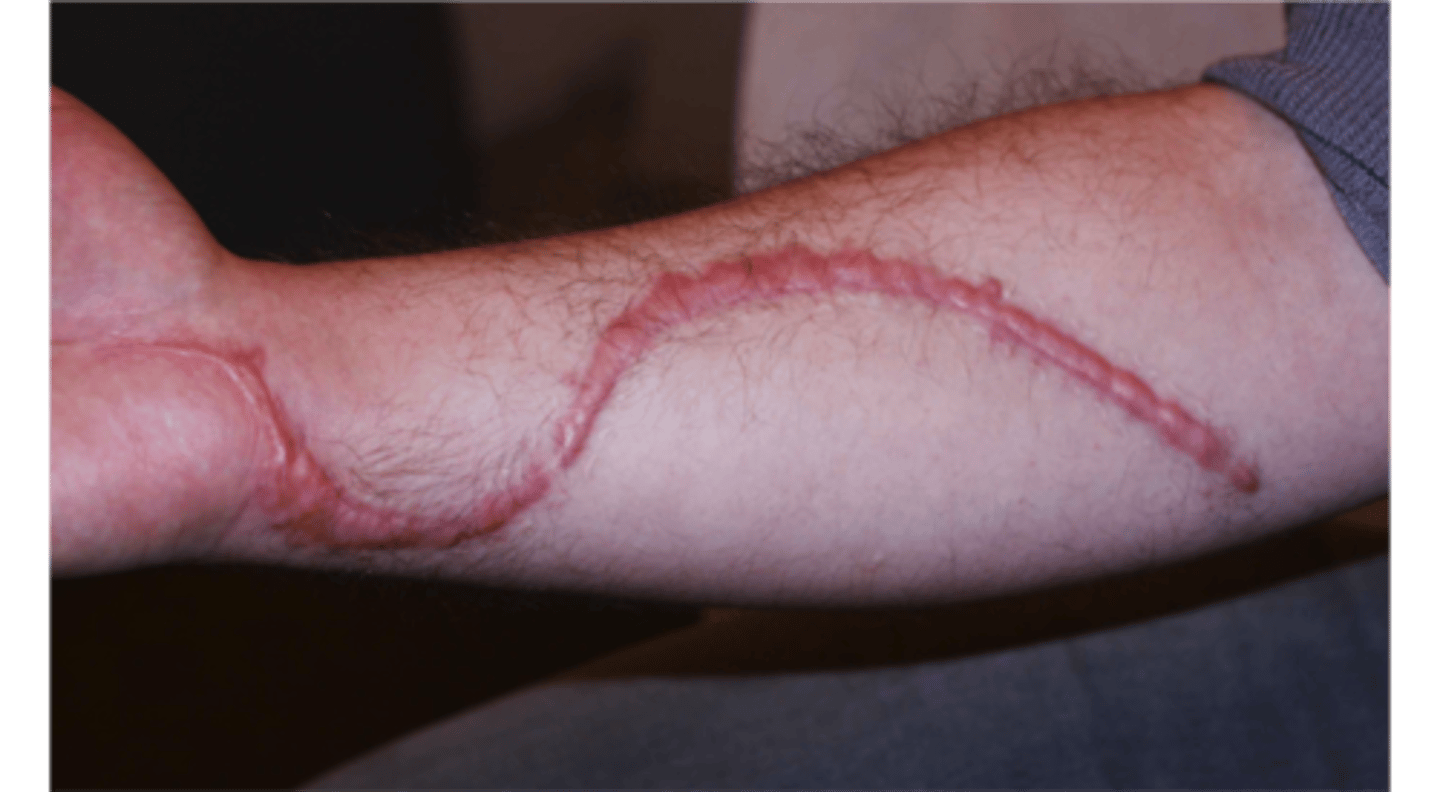 <p>secondary lesion; slightly raised or depressed area of skin that forms as a result of the healing process related to an injury or lesion</p>