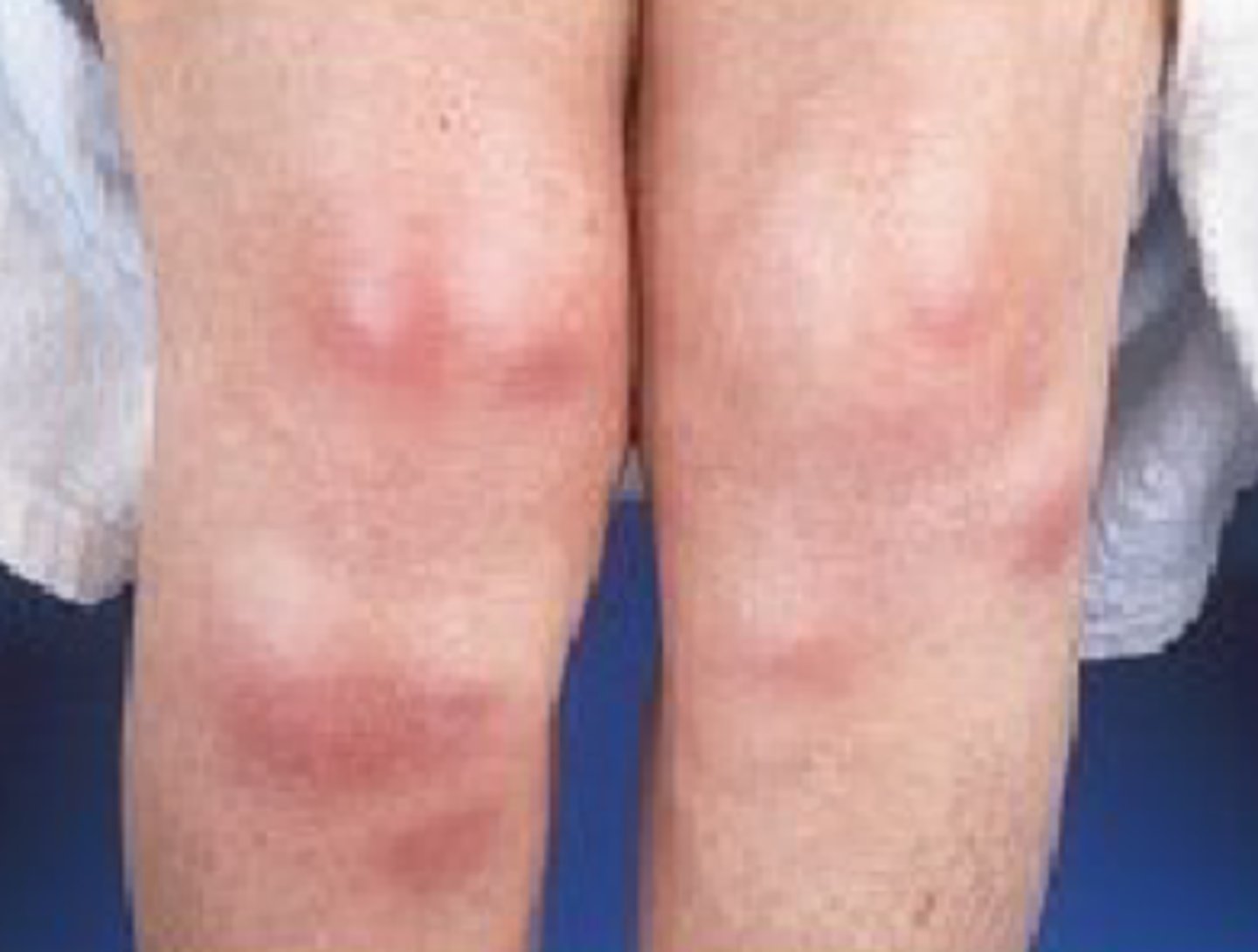 <p>= wanneer nodulus &gt; 1 cm</p>