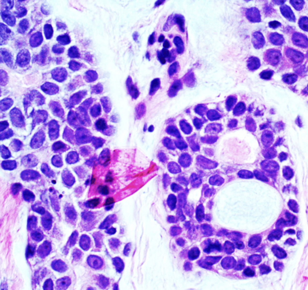 <p>These histologic characteristics are indicative of what oral pathology?</p><p>Swiss cheese pattern</p><p>Islands with cribiform pattern</p><p>Myoepithelial cells and ductal cells present</p><p>Perineural and perivascular invasion</p>