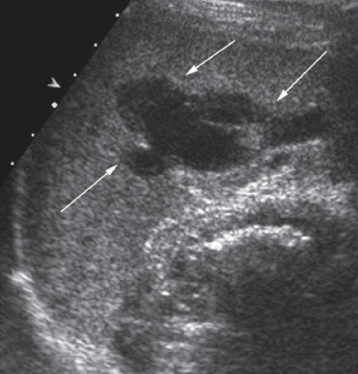 <p>Within splenic parenchyma</p>