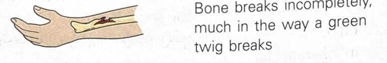 <p>fracture in which bone is broken incompletely</p>