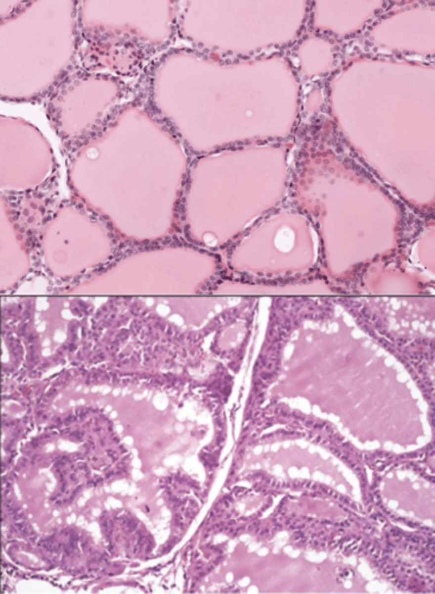 <p>A 40-year-old female patient presents heat intolerance, easy nervousness, difficulty sleeping. Her eyes are bulging as the picture below.</p><p>Her physical examination shows weight loss, increased heart rate. Her neck examination shows a soft, diffuse, nonnodular midline mass that is mobile on swallowing.</p><p>The histologic appearance of this organ on the neck under normal health condition would show as the picture on the top. The histologic examination of this patient shows as the picture on the bottom.</p><p>List the cell types in the epithelium and describe their functions.</p>