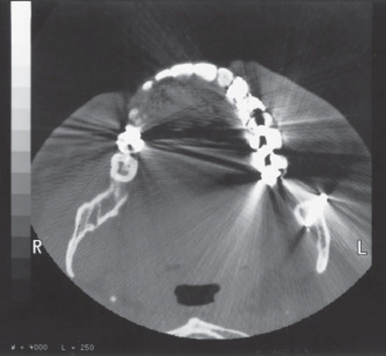 <p>These streaking artifacts were most likely caused by:</p>