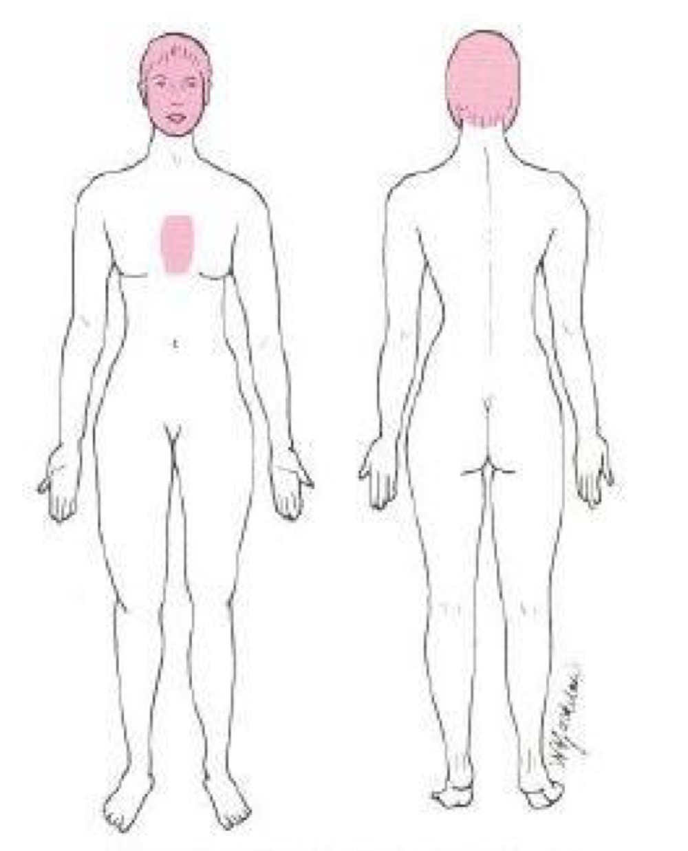 <p>what distribution of skin lesion is this </p>