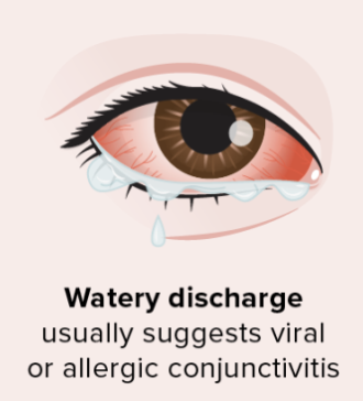 <ul><li><p><strong><mark data-color="blue" style="background-color: blue; color: inherit">Watery discharge</mark></strong></p></li><li><p><strong><mark data-color="red" style="background-color: red; color: inherit">Red / Sore / Burning / Gritty / Swollen eyes</mark></strong></p></li><li><p><strong><mark data-color="blue" style="background-color: blue; color: inherit">Often contagious → Starting in one eye and spreading to both </mark></strong></p></li></ul><p></p>