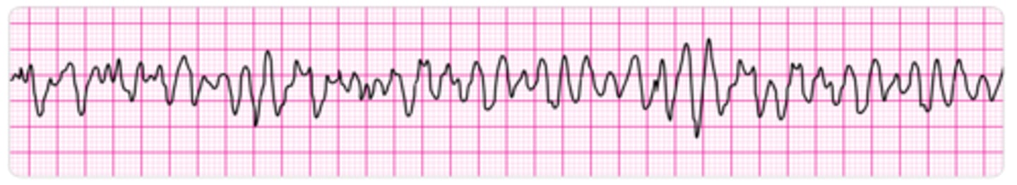 <p>Numerous ventricular foci pacing rapidly leads to twitching rather than contracting &amp; subsequent lack of heart pumping; disorganized, erratic impulses of varying amplitude</p>