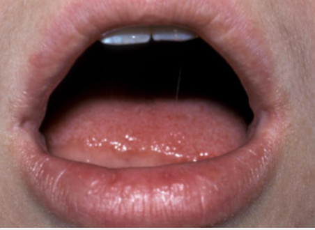 <p><span>Mucosal invaginations that occur at the corners of the mouth on the vermilion border</span></p>