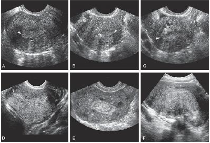 <p>Adenomyosis</p>