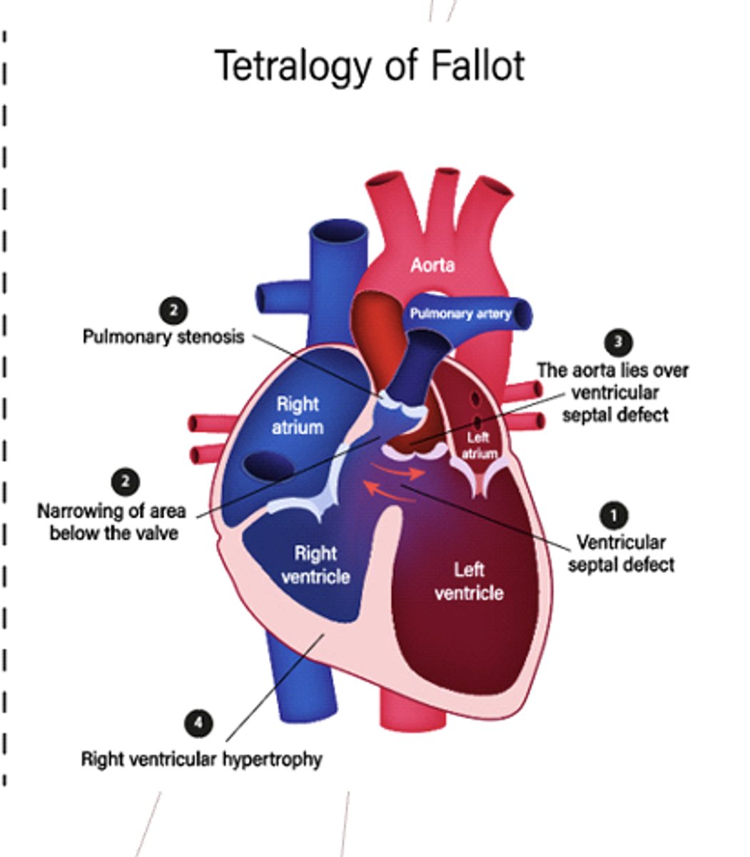 <p>1. VSD</p><p>2. Overriding aorta</p><p>3. Right ventricular hypertrophy</p><p>4. Pulmonary stenosis</p>