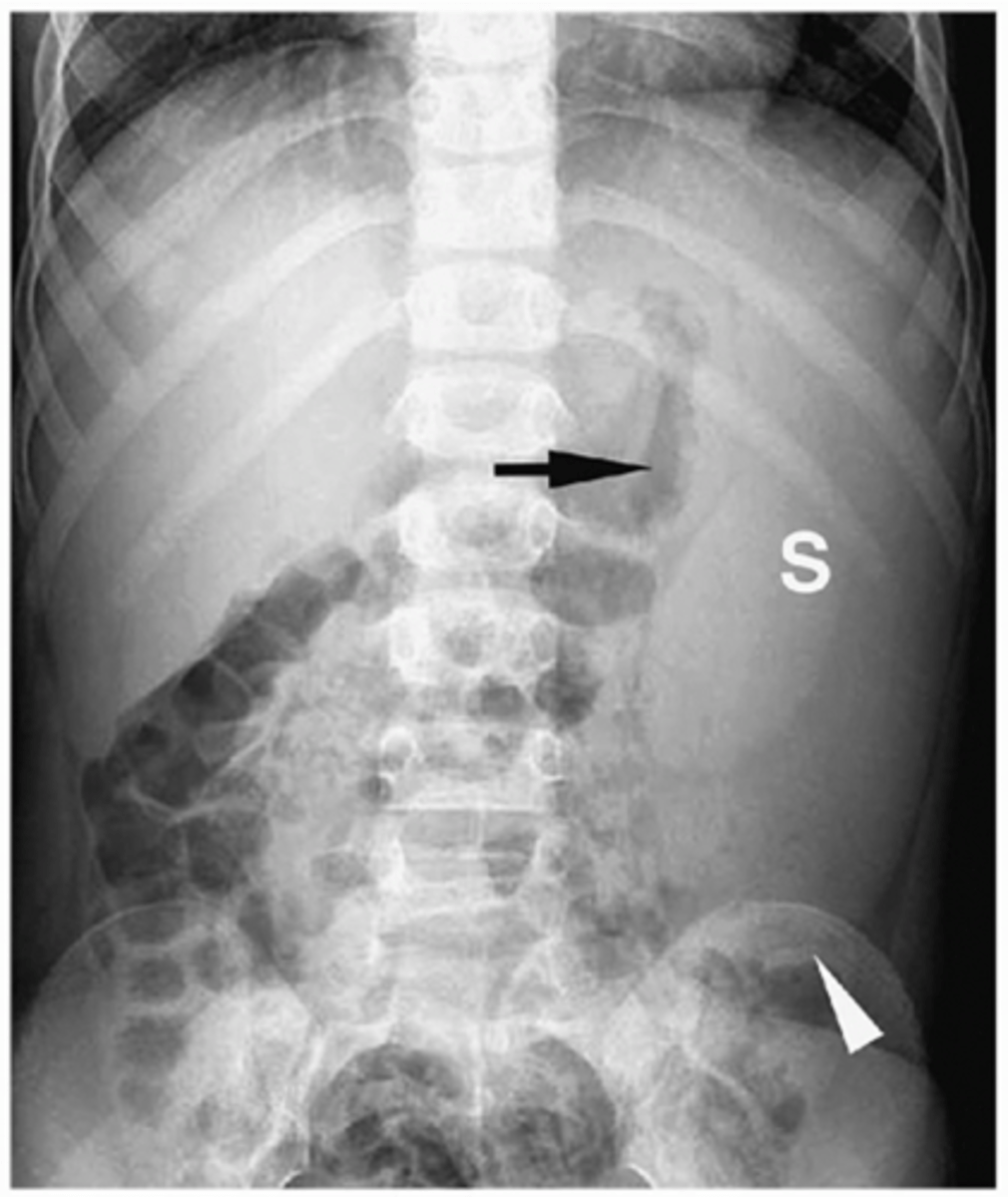<p>enlarged spleen, projects well below 12th posterior rib</p>