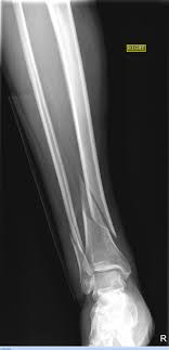 a fracture in which the bone has been twisted apart
