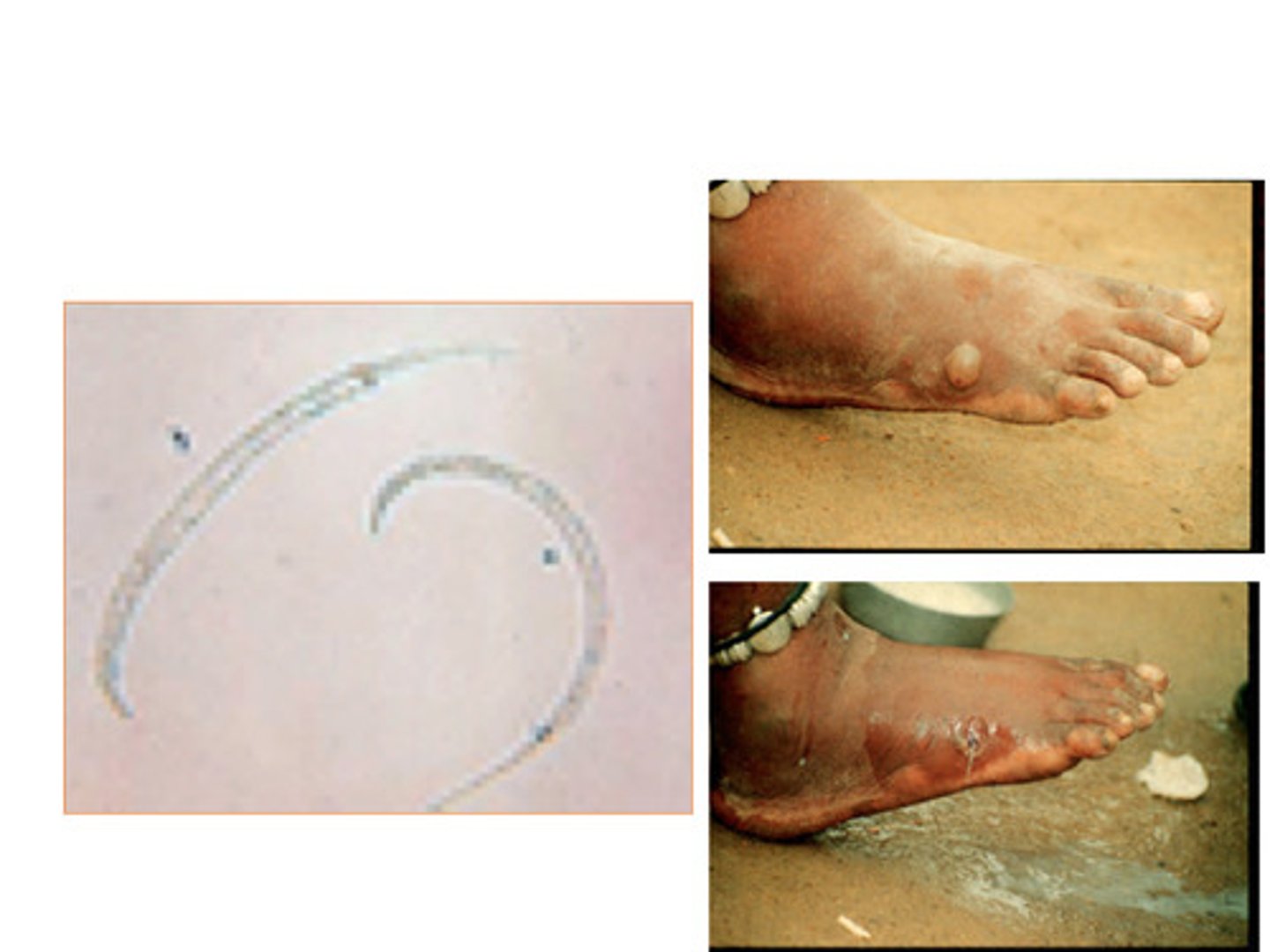 <p>Guinea worm</p>