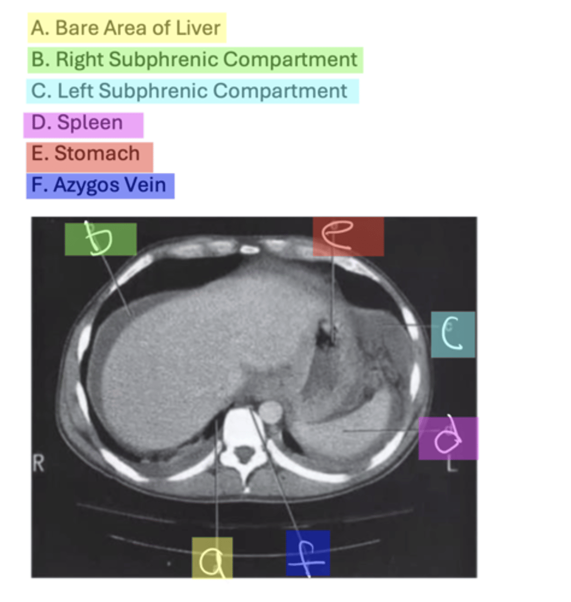 <p>A. Bare Area of Liver</p><p>B. Right Subphrenic Compartment</p><p>C. Left Subphrenic Compartment</p><p>D. Spleen</p><p>E. Stomach</p><p>F. Azygos Vein</p>