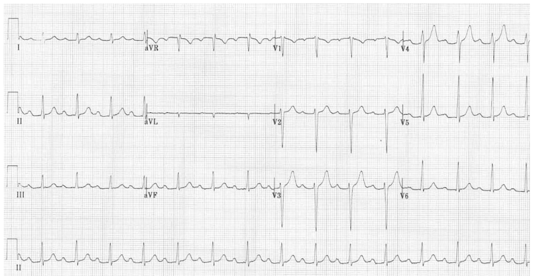 <p>Treatment of a 1st degree AV block</p>