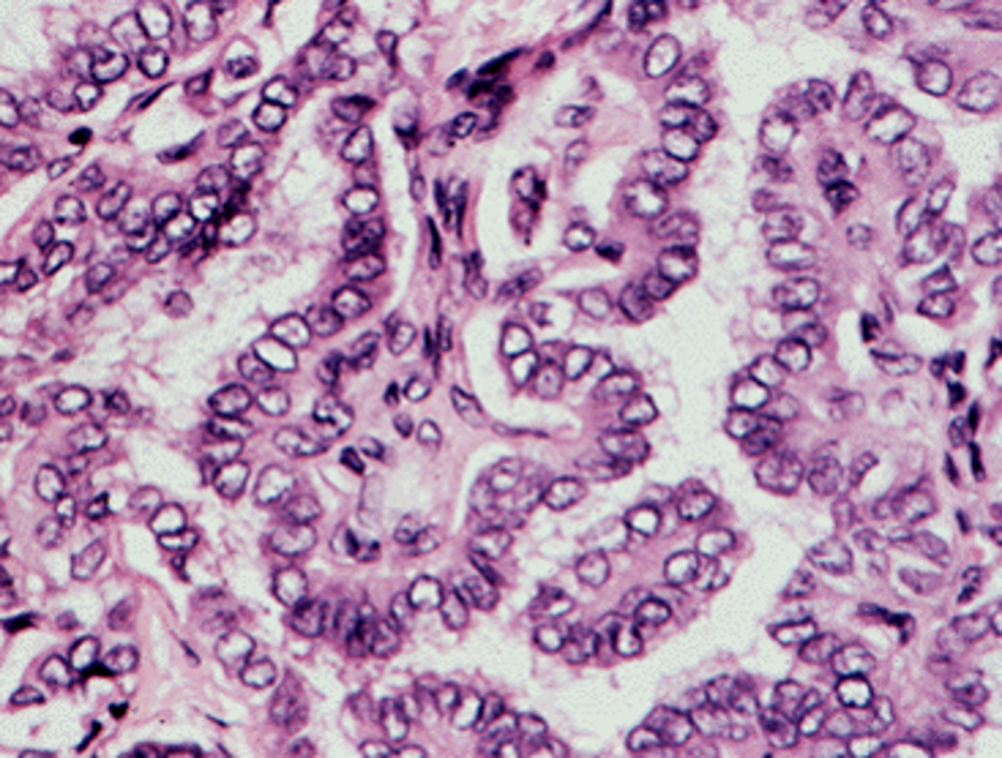 <p>slow growing tumor characterized by papillary pattern with distinctive nulcar features</p>